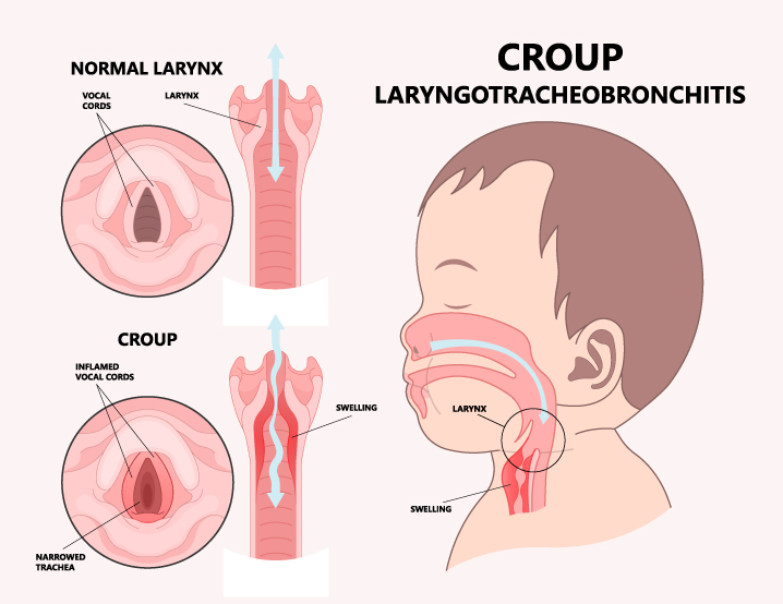Croup Narrows the trachea, croup relieve symptoms with hush vaporiser